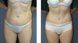 abdominoplasty_p3