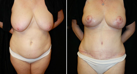 abdominoplasty_pt5