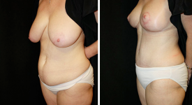 abdominoplasty_pt5a