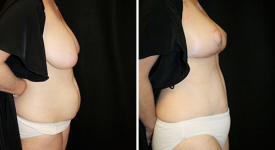 abdominoplasty_pt5b