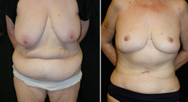 abdominoplasty_pt6