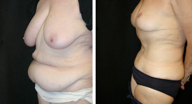 abdominoplasty_pt6a