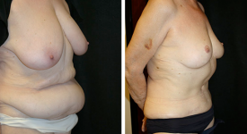 abdominoplasty_pt6b