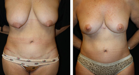 abdominoplasty_pt8a