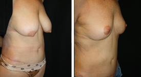 abdominoplasty_pt8c