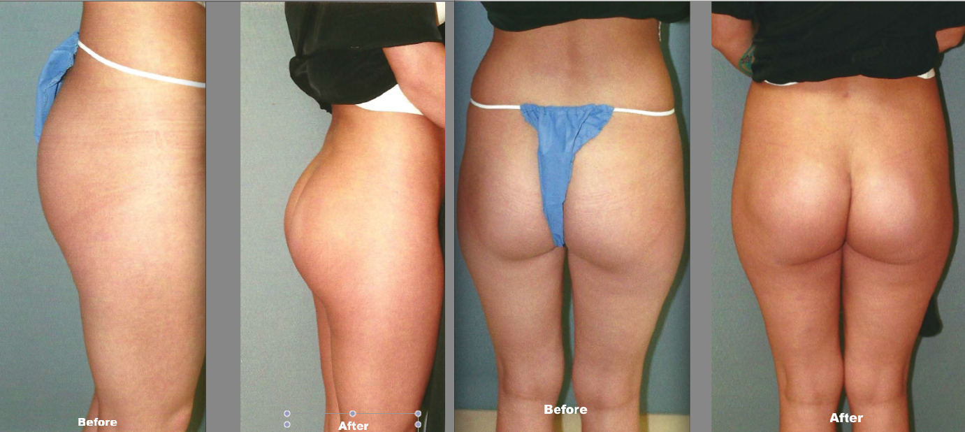 before and after butt lift